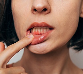 Gum disease is a bacterial infection of the gums