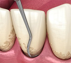 Illustration of scaler being used to clean inside gum pockets