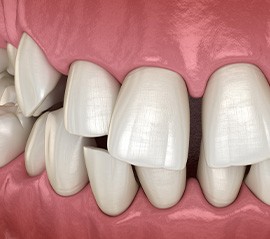 Illustration of gapped teeth