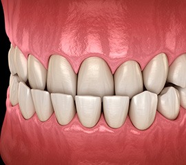 Illustration of an underbite