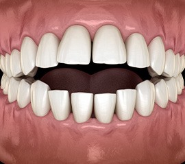 Illustration of an open bite