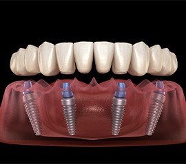 Digital image of All-on-4 Dentures